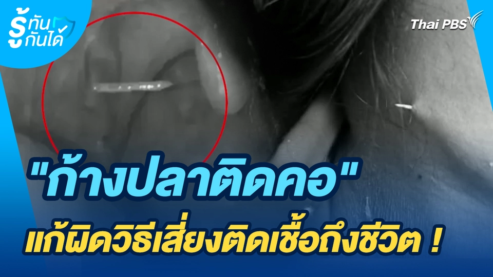 รู้ทันกันได้ : "ก้างปลาติดคอ" แก้ผิดวิธีเสี่ยงติดเชื้อถึงชีวิต !