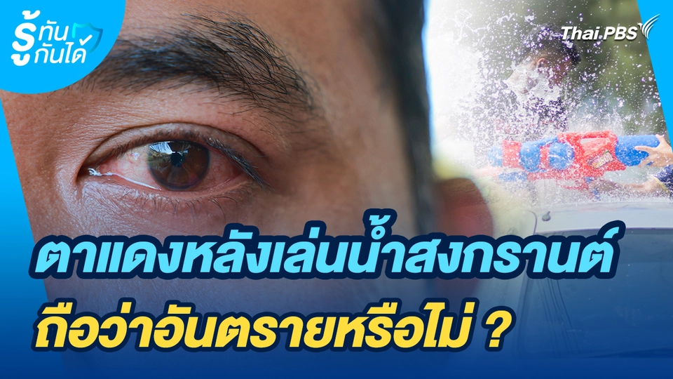 รู้ทันกันได้ : อาการตาแดงหลังเล่นน้ำสงกรานต์ ถือว่าอันตรายหรือไม่ ?