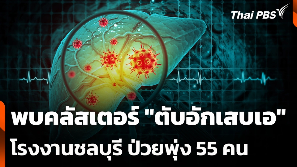 พบคลัสเตอร์ "ตับอักเสบเอ" โรงงานชลบุรี ป่วยพุ่ง 55 คน