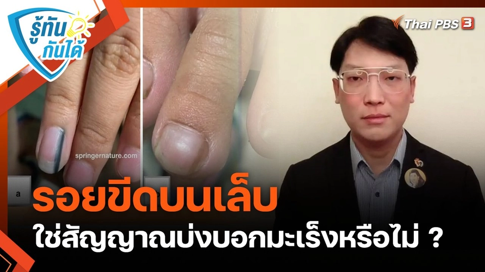 รู้ทันกันได้ : "รอยขีดบนเล็บ" ใช่สัญญาณบ่งบอกมะเร็งหรือไม่ ?