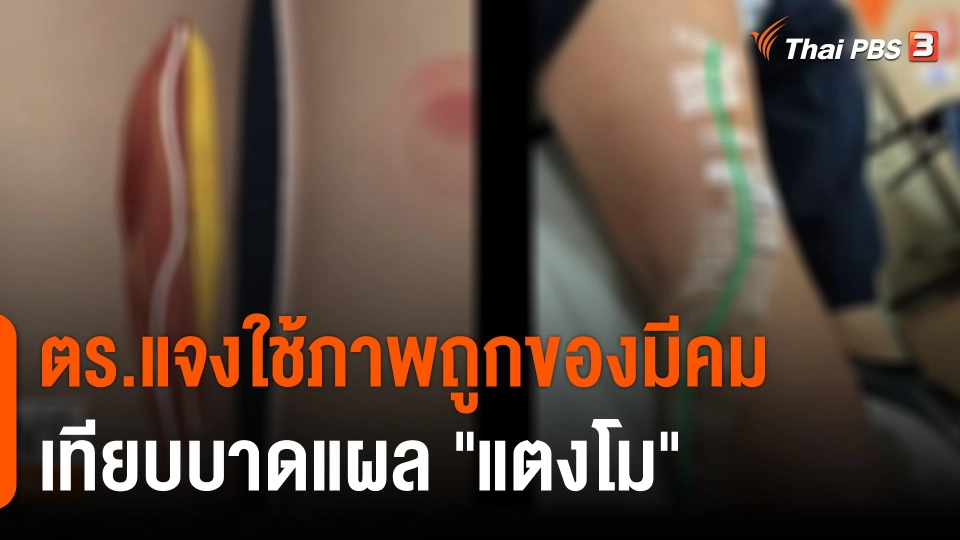 ตร.แจงใช้ภาพถูกของมีคม เทียบบาดแผล "แตงโม"