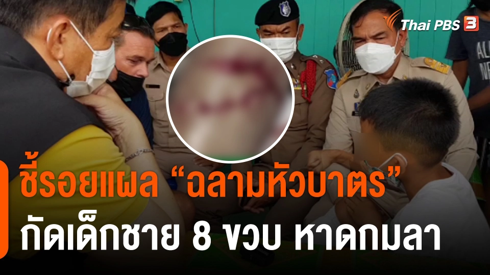 ชี้รอยแผล "ฉลามหัวบาตร" กัดเด็กชาย 8 ขวบ หาดกมลา จ.ภูเก็ต