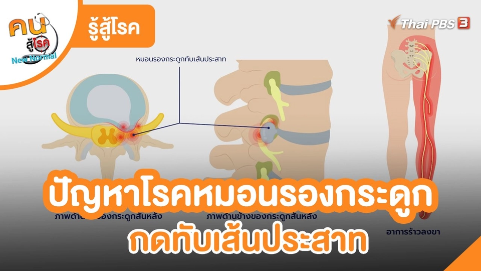 ​รู้สู้โรค : ปัญหาโรคหมอนรองกระดูกกดทับเส้นประสาท
