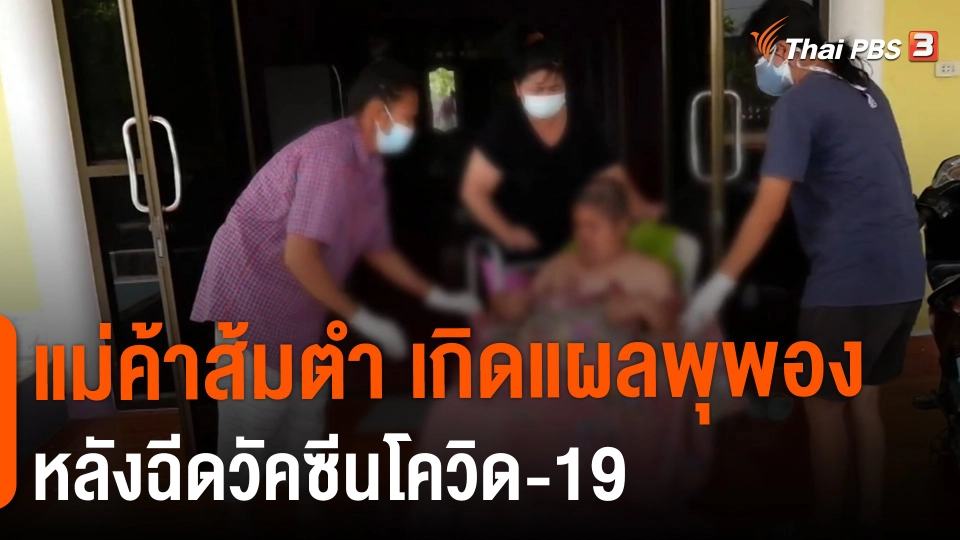 ​แม่ค้าส้มตำ เกิดแผลพุพอง หลังฉีดวัคซีนโควิด-19​