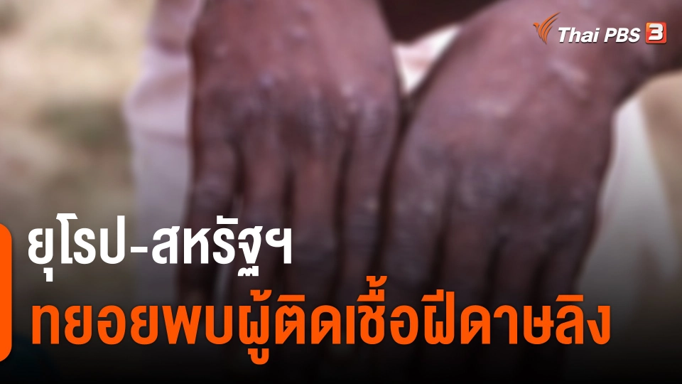 ​ยุโรป-สหรัฐฯ ทยอยพบผู้ติดเชื้อฝีดาษลิง