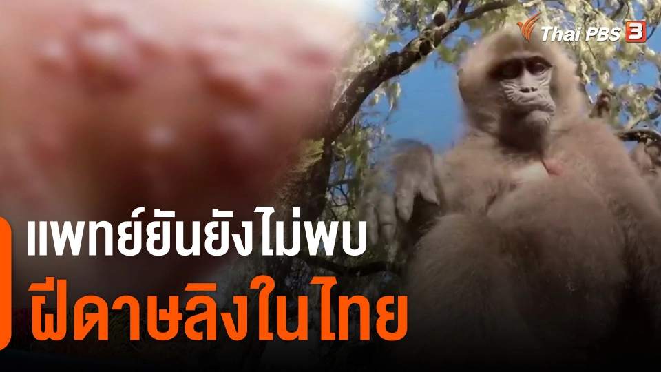 ​เเพทย์ยันยังไม่พบฝีดาษลิงในไทย