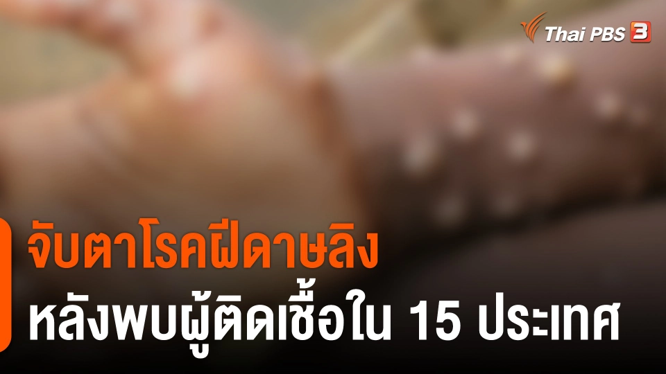 วิเคราะห์สถานการณ์ต่างประเทศ : จับตาโรคฝีดาษลิงหลังพบผู้ติดเชื้อใน 15 ประเทศ