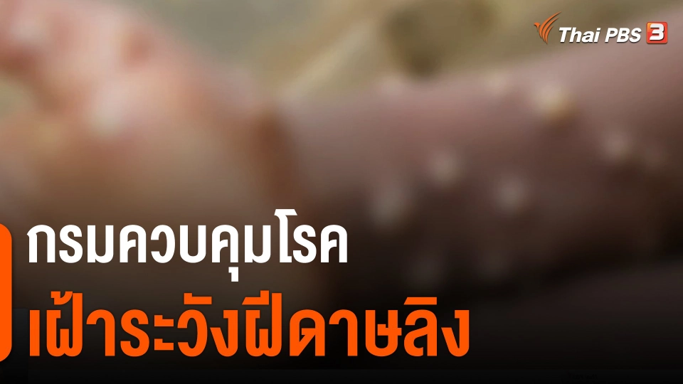 ​กรมควบคุมโรคเฝ้าระวังฝีดาษลิง