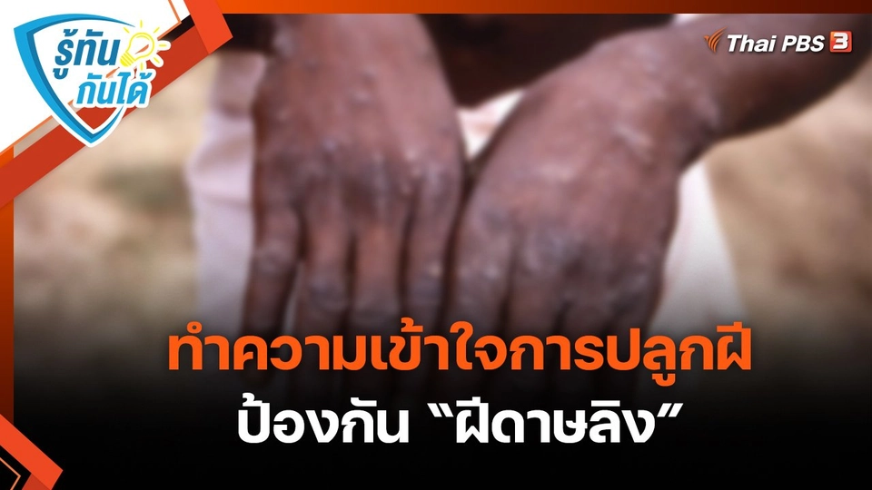 รู้ทันกันได้ : ทำความเข้าใจการปลูกฝีป้องกัน “ฝีดาษลิง”