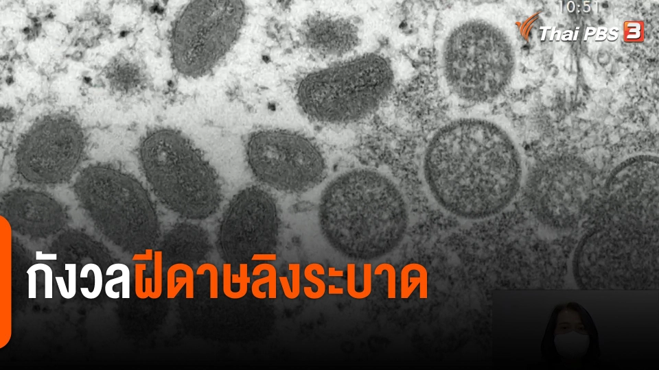 กังวลฝีดาษลิงระบาด