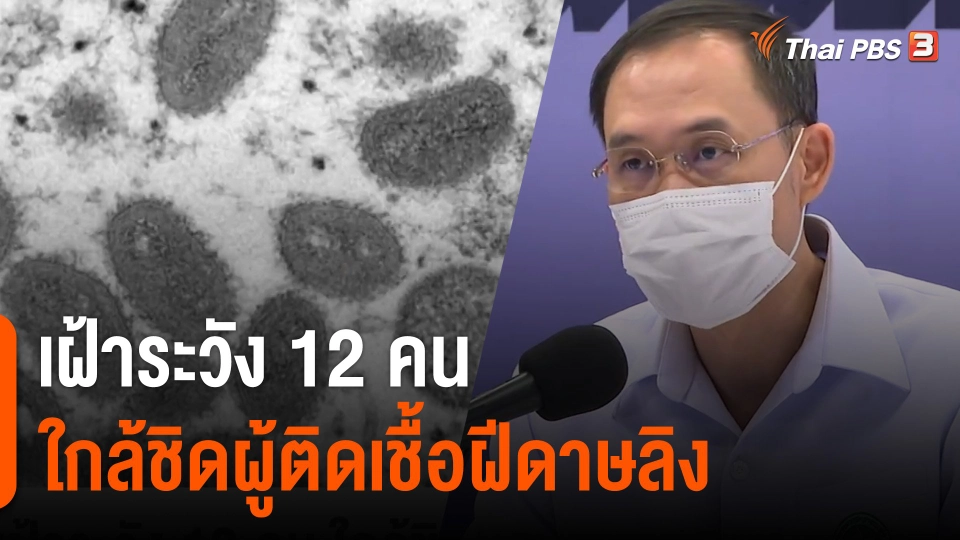 เฝ้าระวัง 12 คน ใกล้ชิดผู้ติดเชื้อฝีดาษลิง
