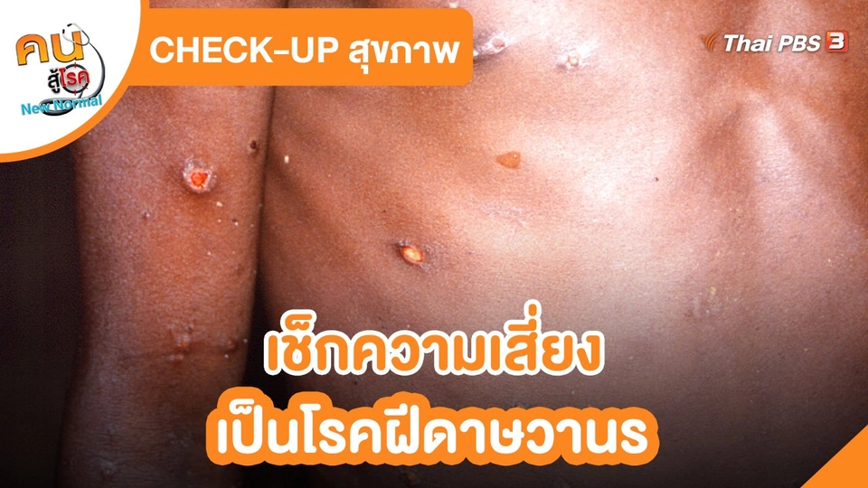 ​Check up สุขภาพ : เช็กความเสี่ยงเป็นโรคฝีดาษวานร​