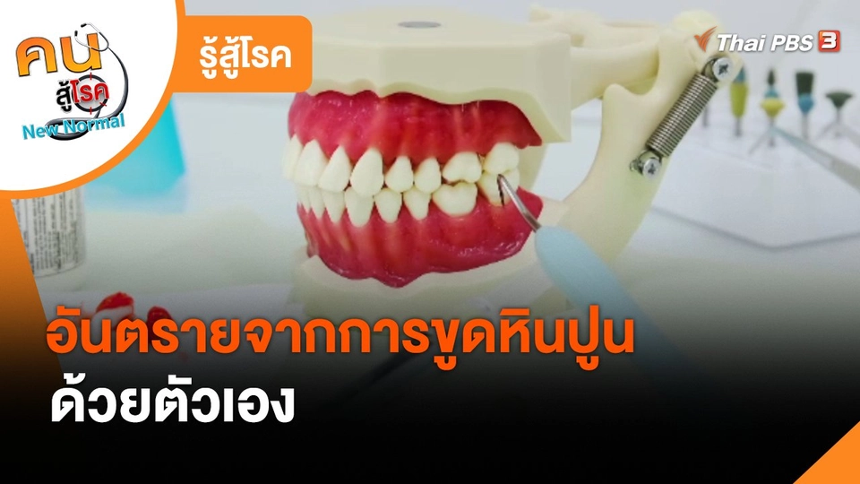 รู้สู้โรค : อันตรายจากการขูดหินปูนด้วยตัวเอง