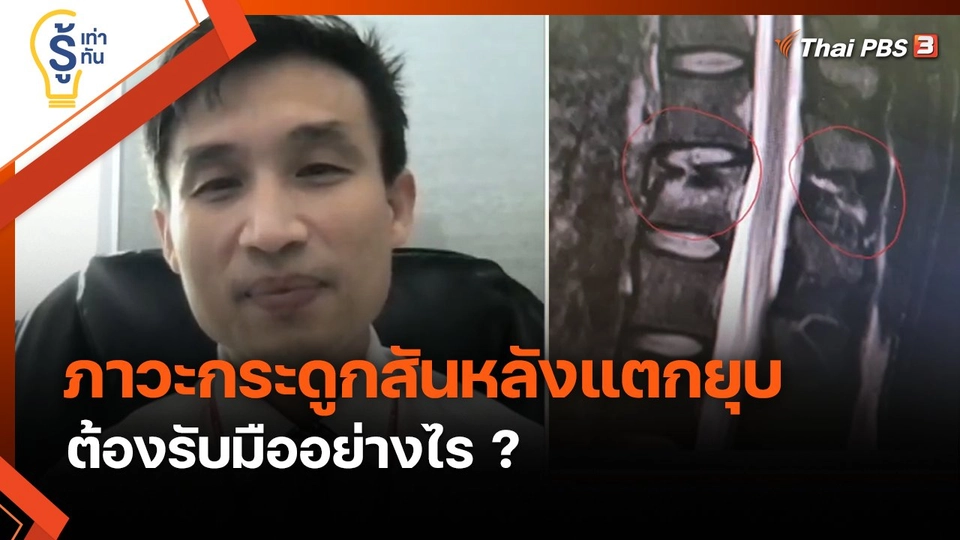 รู้เท่ารู้ทัน : รู้ทัน "ภาวะกระดูกสันหลังแตกยุบ" ต้องรับมืออย่างไร ?