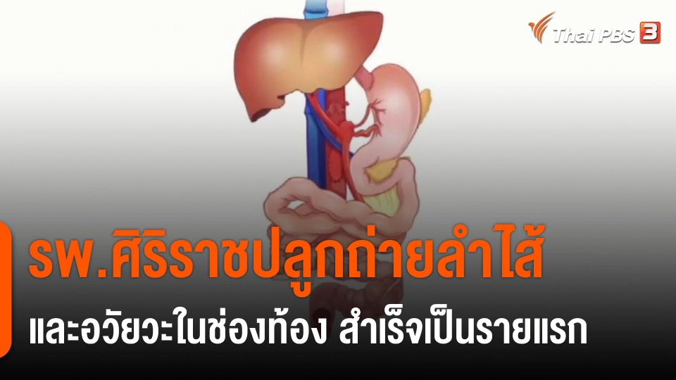 ​รพ.ศิริราชปลูกถ่ายลำไส้และอวัยวะในช่องท้อง สำเร็จเป็นรายแรก