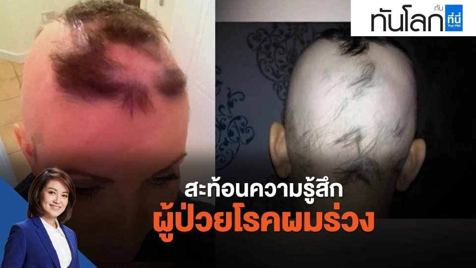 สะท้อนความรู้สึกผู้ป่วยโรคผมร่วง