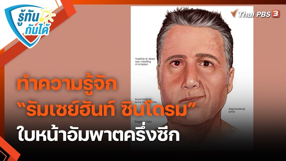 ​รู้ทันกันได้ : ทำความรู้จัก “รัมเซย์ฮันท์ ซินโดรม” ใบหน้าอัมพาตครึ่งซีก