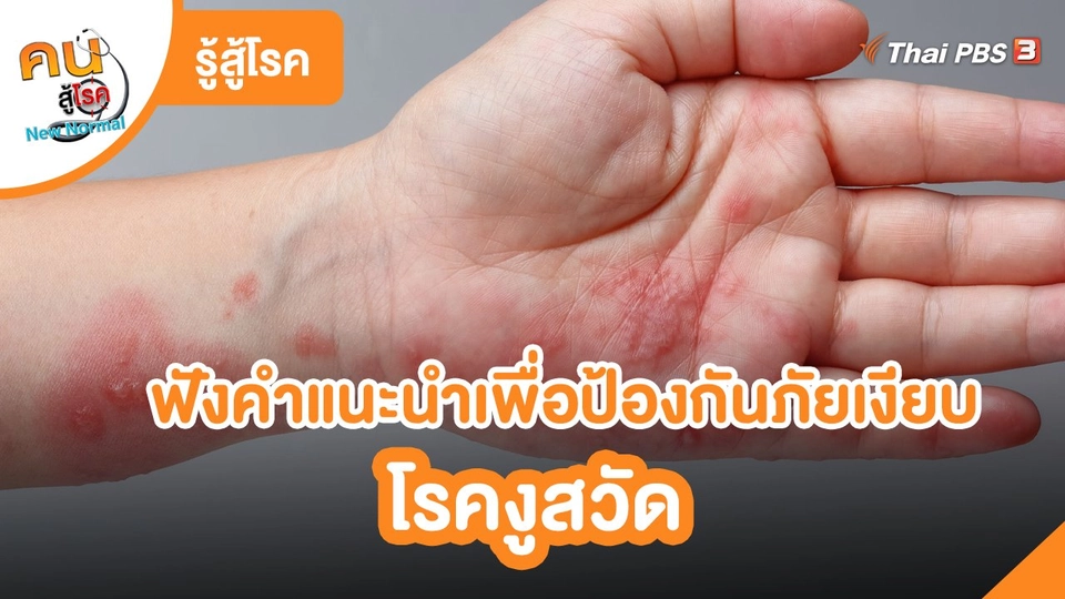 รู้สู้โรค : ฟังคำแนะนำเพื่อป้องกันภัยเงียบโรคงูสวัด