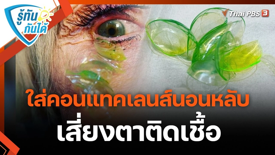 ​รู้ทันกันได้ : ใส่คอนแทคเลนส์นอนหลับ เสี่ยงตาติดเชื้อ