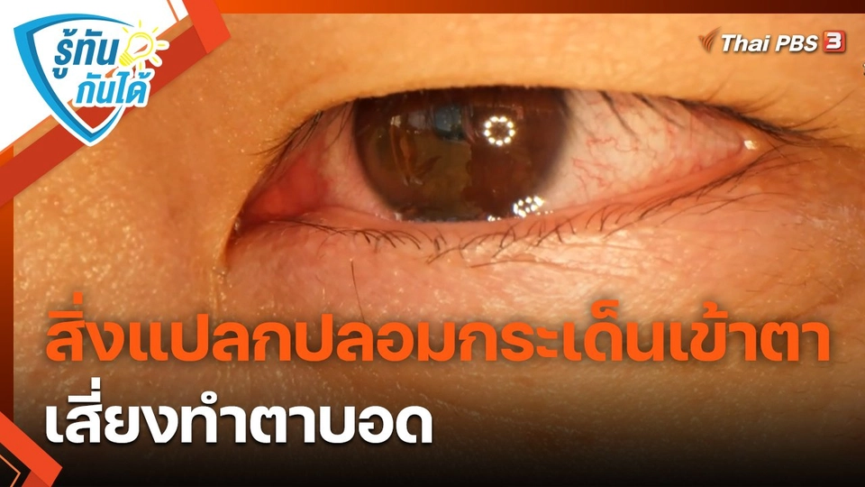 รู้ทันกันได้ : สิ่งแปลกปลอมกระเด็นเข้าตา เสี่ยงทำตาบอด