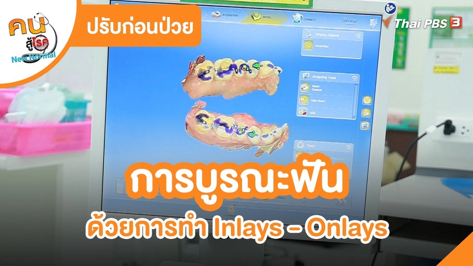 ​ปรับก่อนป่วย : การบูรณะฟันด้วยการทำ Inlays - Onlays