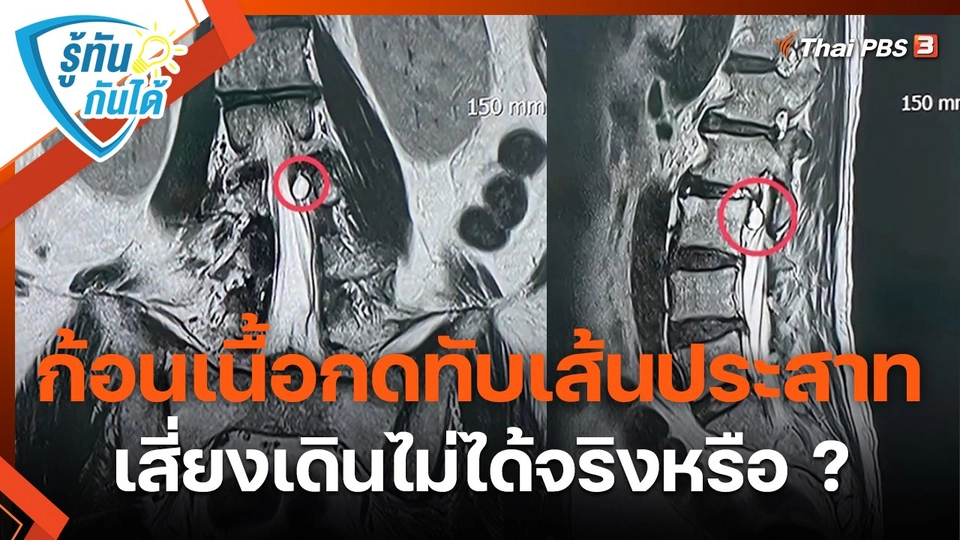 รู้ทันกันได้ : ก้อนเนื้อกดทับเส้นประสาท เสี่ยงเดินไม่ได้จริงหรือ ?