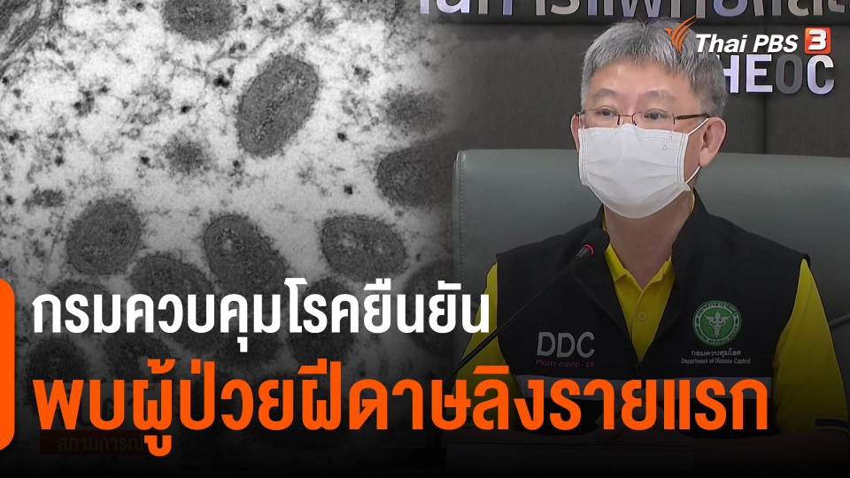 ​กรมควบคุมโรคยืนยันพบผู้ป่วยฝีดาษลิงรายแรก