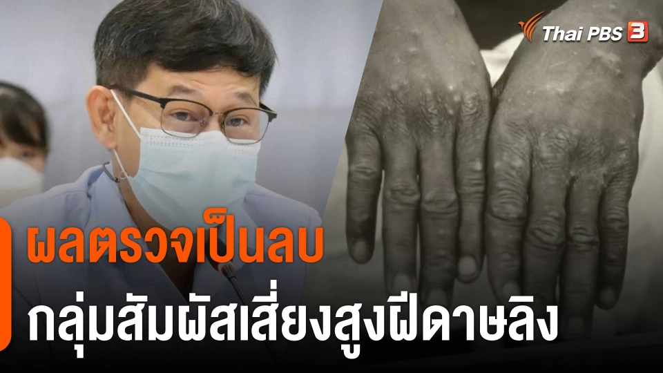 ผลตรวจเป็นลบ กลุ่มเสี่ยงฝีดาษลิง 19 คน ใกล้ชิดชายชาวไนจีเรีย