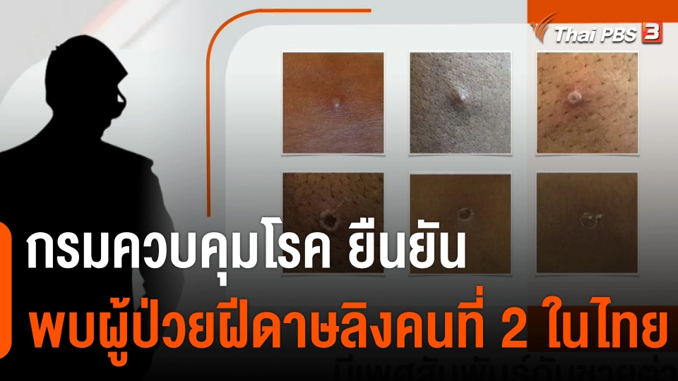 กรมควบคุมโรค ยืนยันพบผู้ป่วยฝีดาษลิงคนที่ 2 ในไทย