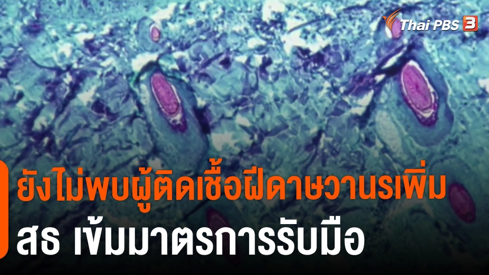 ยังไม่พบผู้ติดเชื้อฝีดาษวานรเพิ่ม สธ.เข้มมาตรการรับมือ