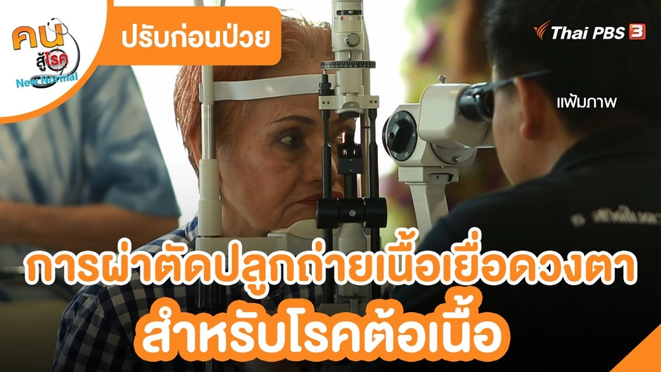 ปรับก่อนป่วย : การผ่าตัดปลูกถ่ายเนื้อเยื่อดวงตา สำหรับโรคต้อเนื้อ
