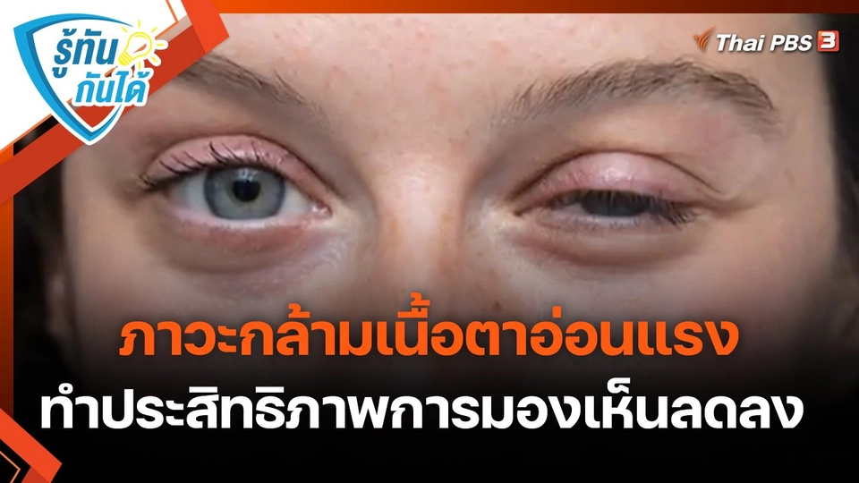 รู้ทันกันได้ : ภาวะกล้ามเนื้อตาอ่อนแรง ทำประสิทธิภาพการมองเห็นลดลง