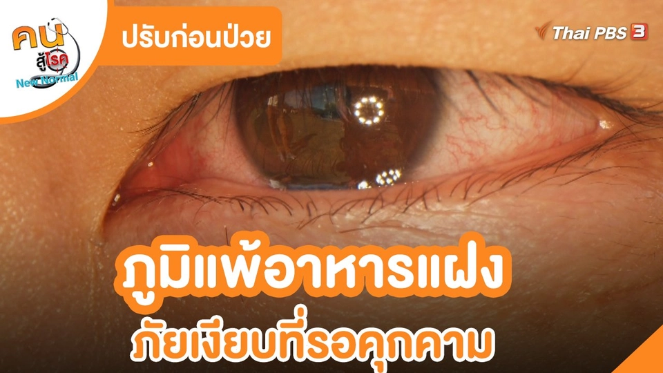 ปรับก่อนป่วย : ภูมิแพ้อาหารแฝง ภัยเงียบที่รอคุกคาม