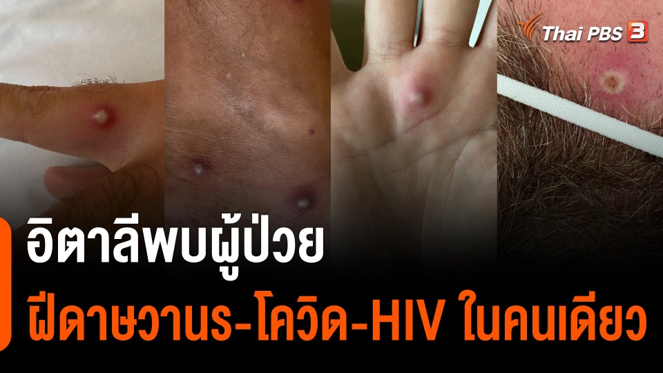 พบผู้ป่วยฝีดาษวานร - โควิด - เอชไอวี ในคนเดียว