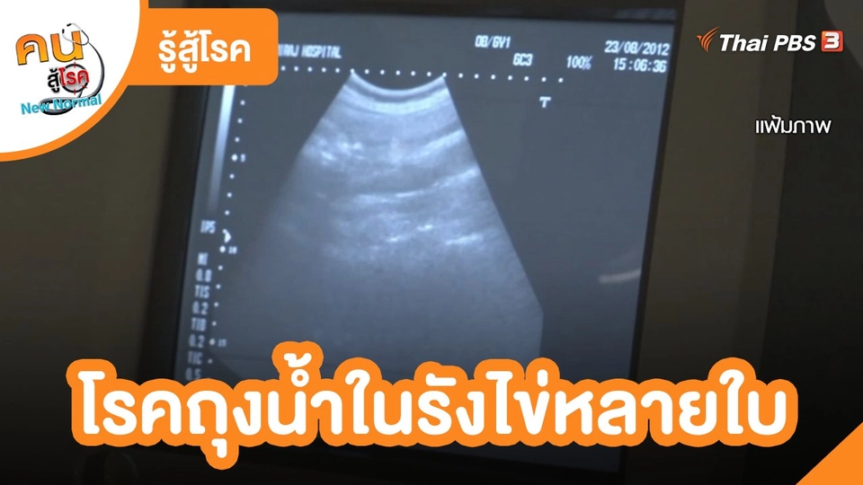 รู้สู้โรค : โรคถุงน้ำในรังไข่หลายใบ (PCOS)