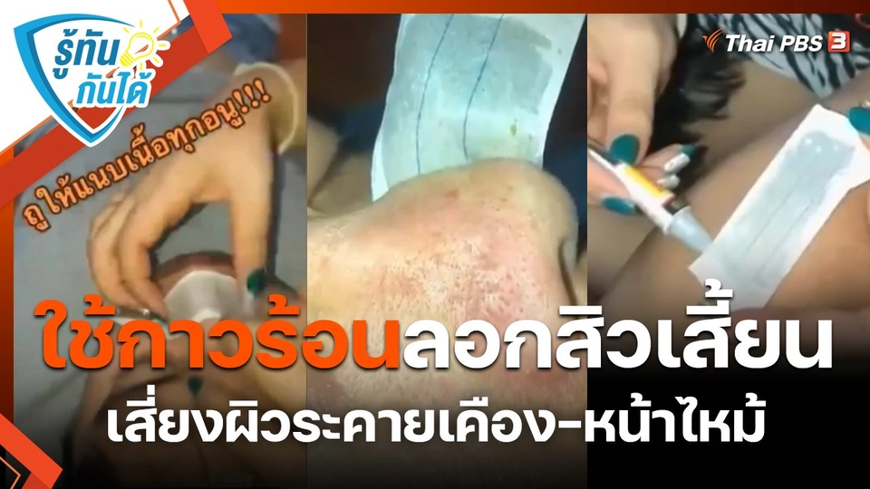 รู้ทันกันได้ : ใช้กาวร้อนลอกสิวเสี้ยน เสี่ยงผิวระคายเคือง-หน้าไหม้