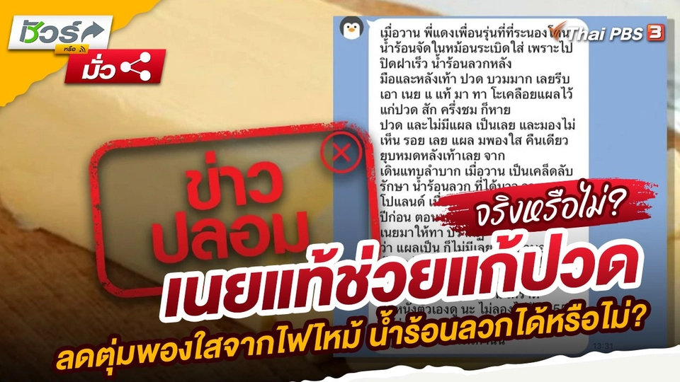 เนยแท้ช่วยแก้ปวด ลดตุ่มพองใสจากไฟไหม้ น้ำร้อนลวกได้หรือไม่?