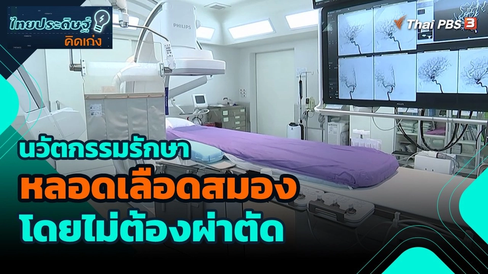 ​ไทยประดิษฐ์คิดเก่ง : นวัตกรรมรักษาหลอดเลือดสมองโดยไม่ต้องผ่าตัด