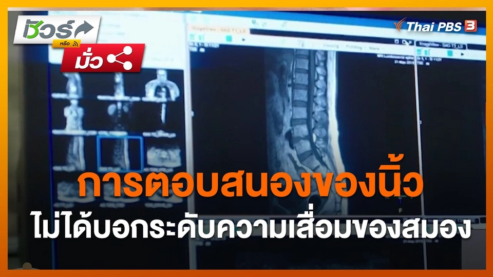 ชัวร์หรือมั่ว : การตอบสนองของนิ้วไม่ได้บอกระดับความเสื่อมของสมอง