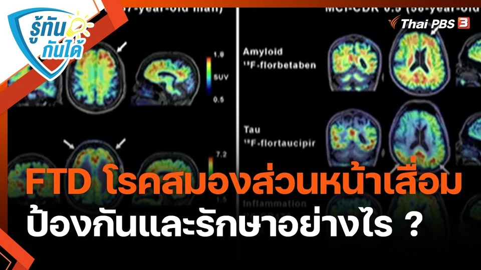 ​รู้ทันกันได้ : FTD โรคสมองส่วนหน้าเสื่อม ป้องกันและรักษาอย่างไร ?