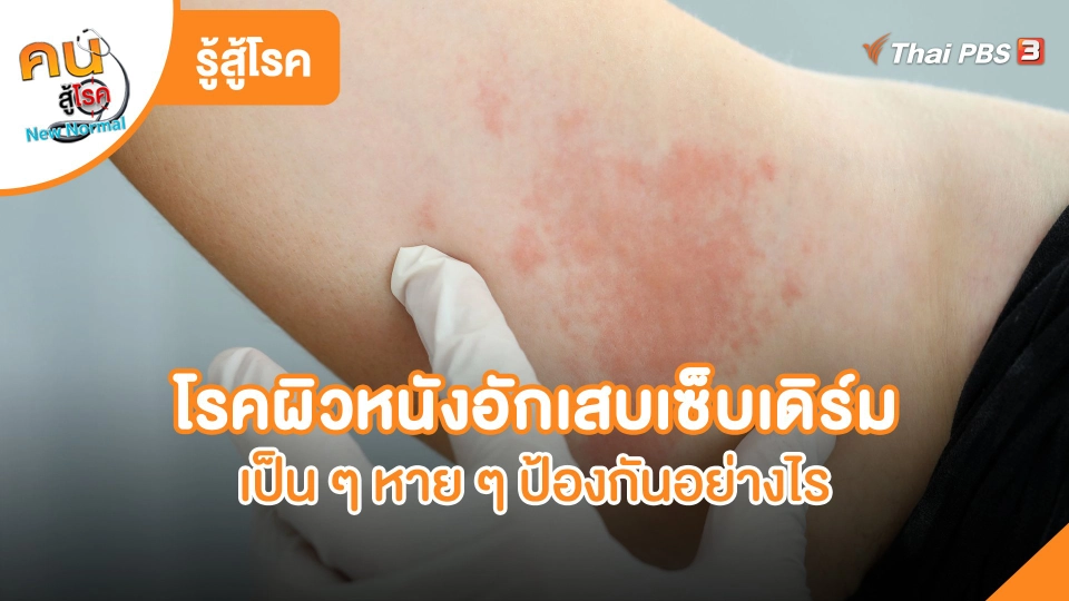 ​รู้สู้โรค : โรคผิวหนังอักเสบเซ็บเดิร์มเป็น ๆ หาย ๆ ป้องกันอย่างไร