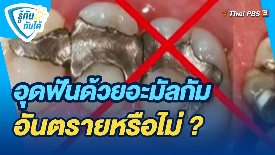 ​รู้ทันกันได้ : อุดฟันด้วยอะมัลกัมอันตรายหรือไม่ ?