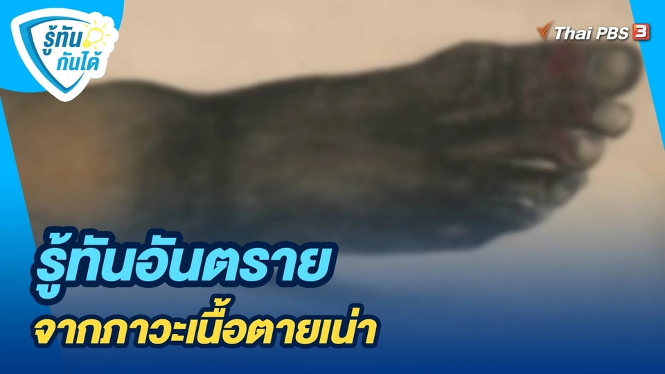 รู้ทันอันตรายจากภาวะเนื้อตายเน่า