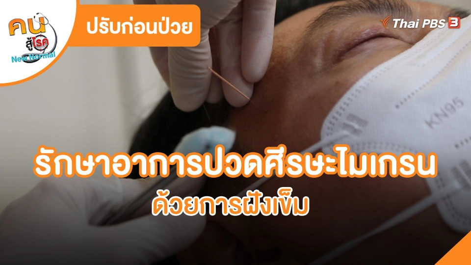 ​ปรับก่อนป่วย : รักษาอาการปวดศีรษะไมเกรนด้วยการฝังเข็ม