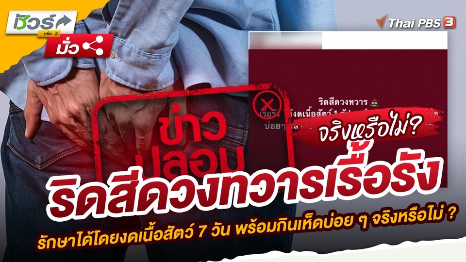 ข่าวปลอม : ริดสีดวงทวารเรื้อรัง รักษาได้โดยงดเนื้อสัตว์ 7 วัน พร้อมกินเห็ดบ่อย ๆ