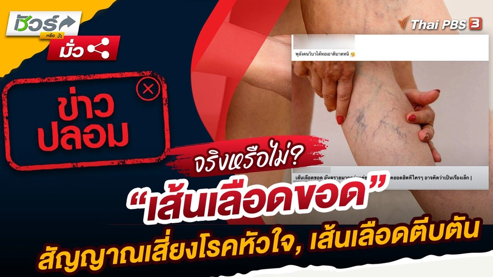 ชัวร์หรือมั่ว : "เส้นเลือดขอด" สัญญาณเสี่ยงโรคหัวใจ, เส้นเลือดตีบตัน จริงหรือ ?