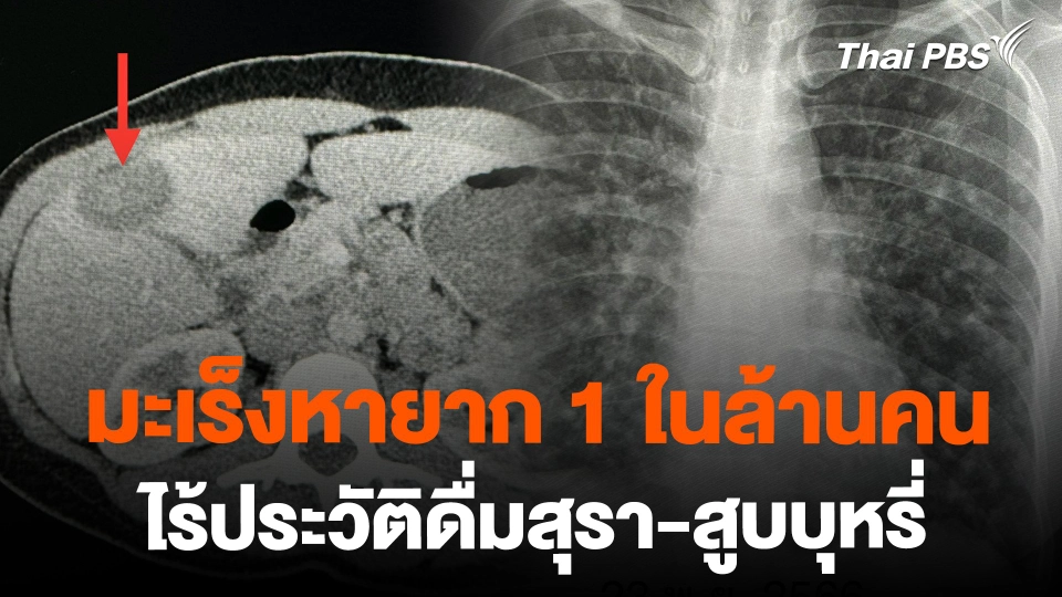 มะเร็งหายาก 1 ในล้านคน ไร้ประวัติดื่มสุรา-สูบบุหรี่