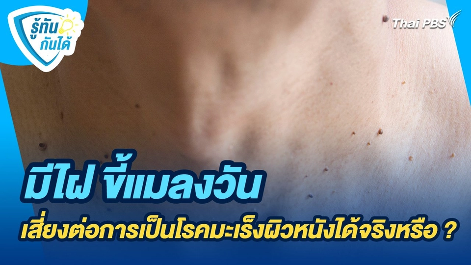 รู้ทันกันได้ : มีไฝ ขี้แมลงวันเสี่ยงต่อการเป็นโรคมะเร็งผิวหนังได้จริงหรือ ?