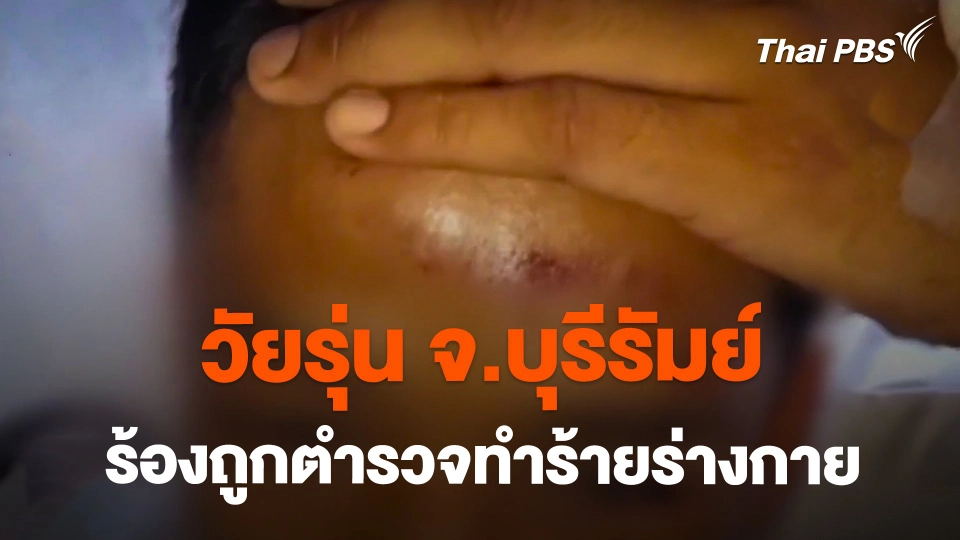 วัยรุ่น จ.บุรีรัมย์ ร้องถูกตำรวจทำร้ายร่างกาย