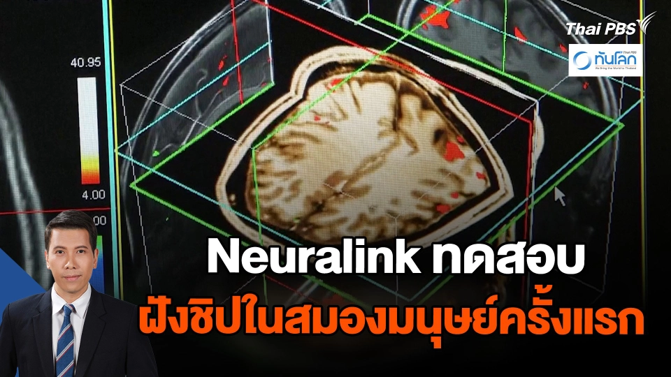 Neuralink ทดสอบฝังชิปในสมองมนุษย์ครั้งแรก